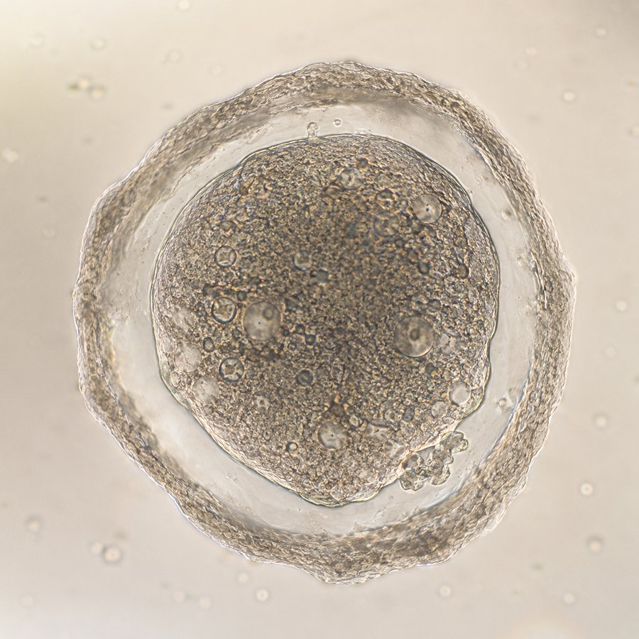 Ilustración de un óvulo de baja calidad: citoplasma oscuro y granular con vacuolas, zona pelúcida engrosada e irregular